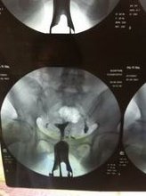 2代试管着床不成功可能有这些原因，胚胎不好会增加失败率